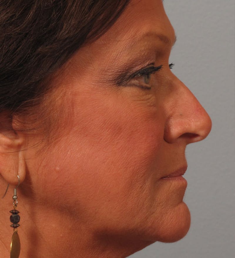 Laser Resurfacing Before & After Gallery - Patient 123191 - Image 1