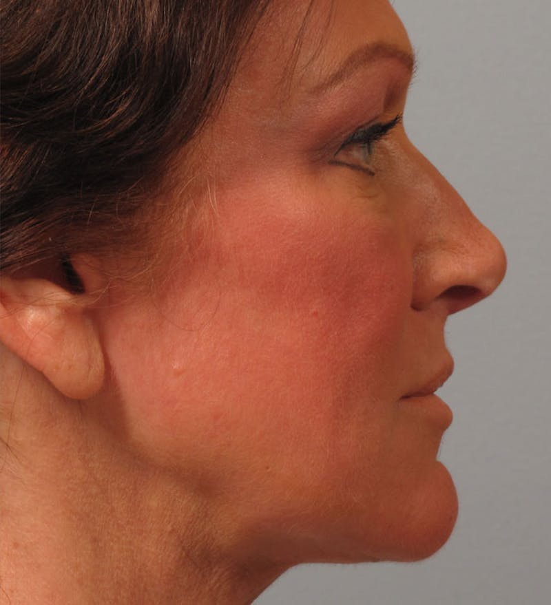 Laser Resurfacing Before & After Gallery - Patient 123191 - Image 2