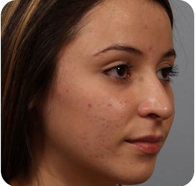 Rhinoplasty Before & After Gallery - Patient 223416 - Image 1