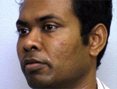 Rhinoplasty Before & After Gallery - Patient 337468 - Image 1