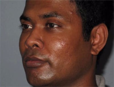 Rhinoplasty Before & After Gallery - Patient 337468 - Image 2