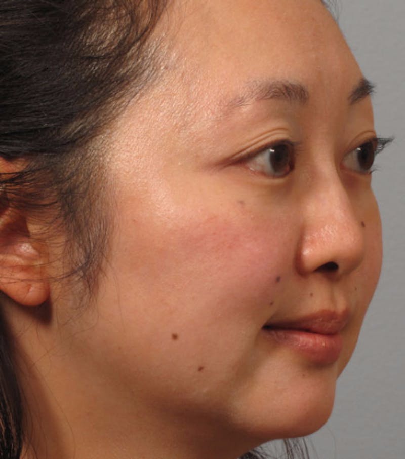 Rhinoplasty Before & After Gallery - Patient 205795 - Image 1