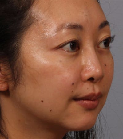 Rhinoplasty Before & After Gallery - Patient 205795 - Image 2