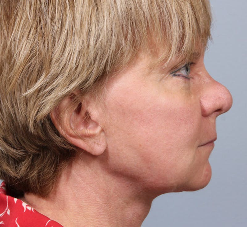 Rhinoplasty Before & After Gallery - Patient 339059 - Image 1