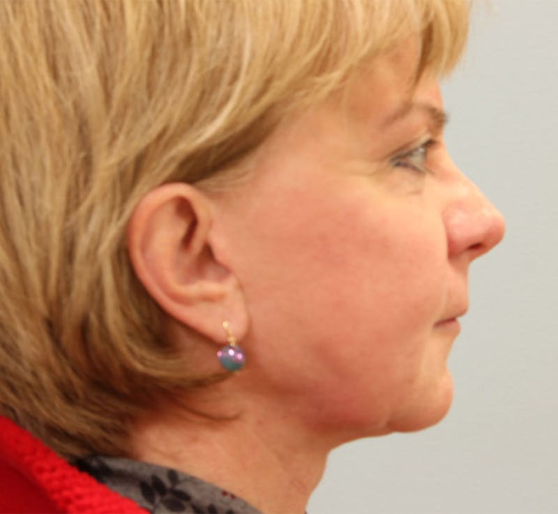 Rhinoplasty Before & After Gallery - Patient 339059 - Image 2