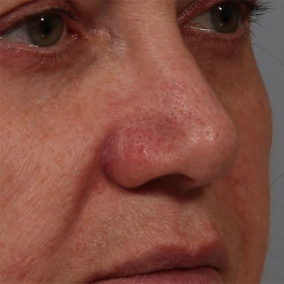 Rhinoplasty Before & After Gallery - Patient 185083 - Image 1