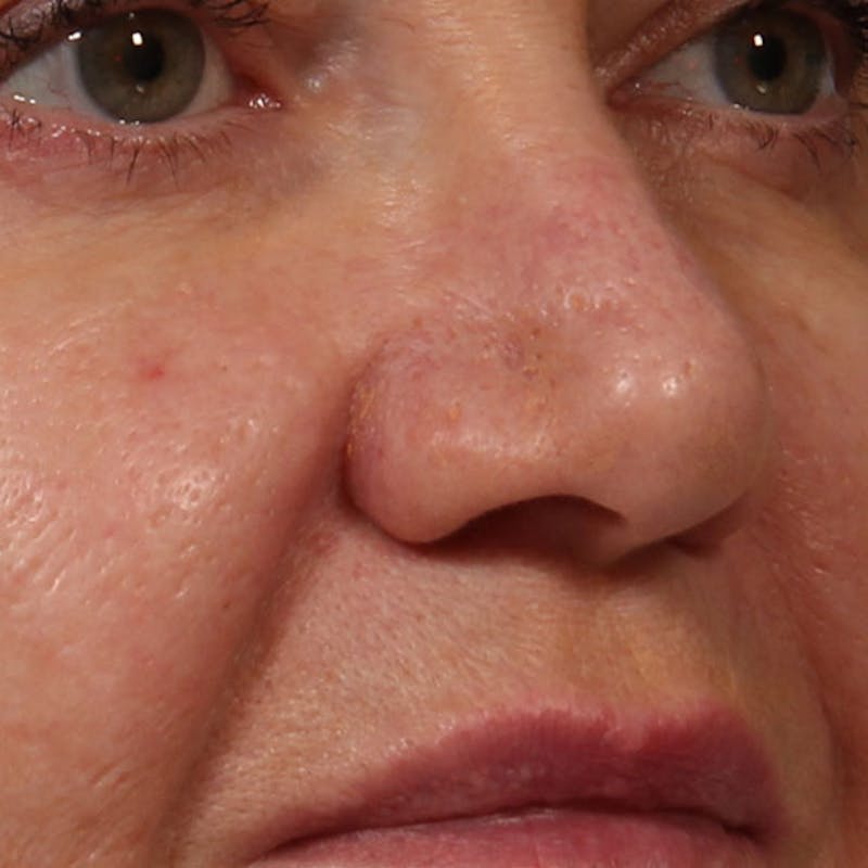 Rhinoplasty Before & After Gallery - Patient 185083 - Image 2