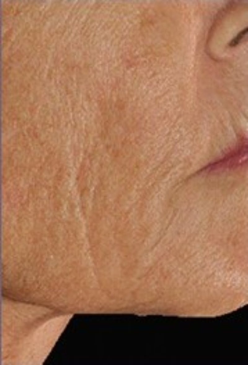 DefenAge Before & After Gallery - Patient 412593 - Image 1