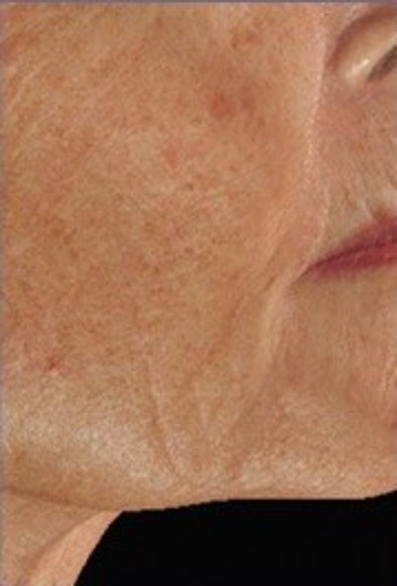 DefenAge Before & After Gallery - Patient 412593 - Image 2