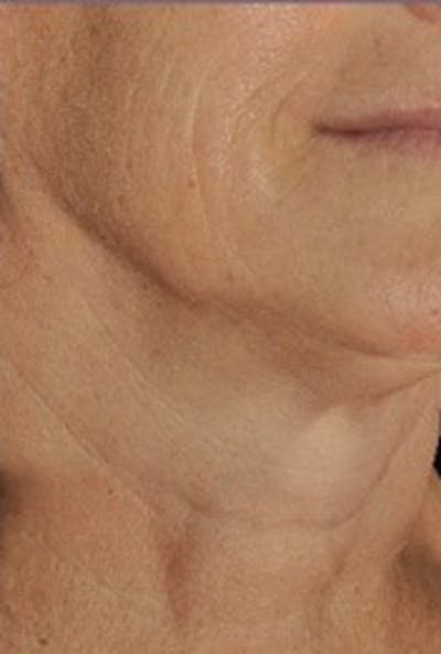 DefenAge Before & After Gallery - Patient 121027 - Image 1