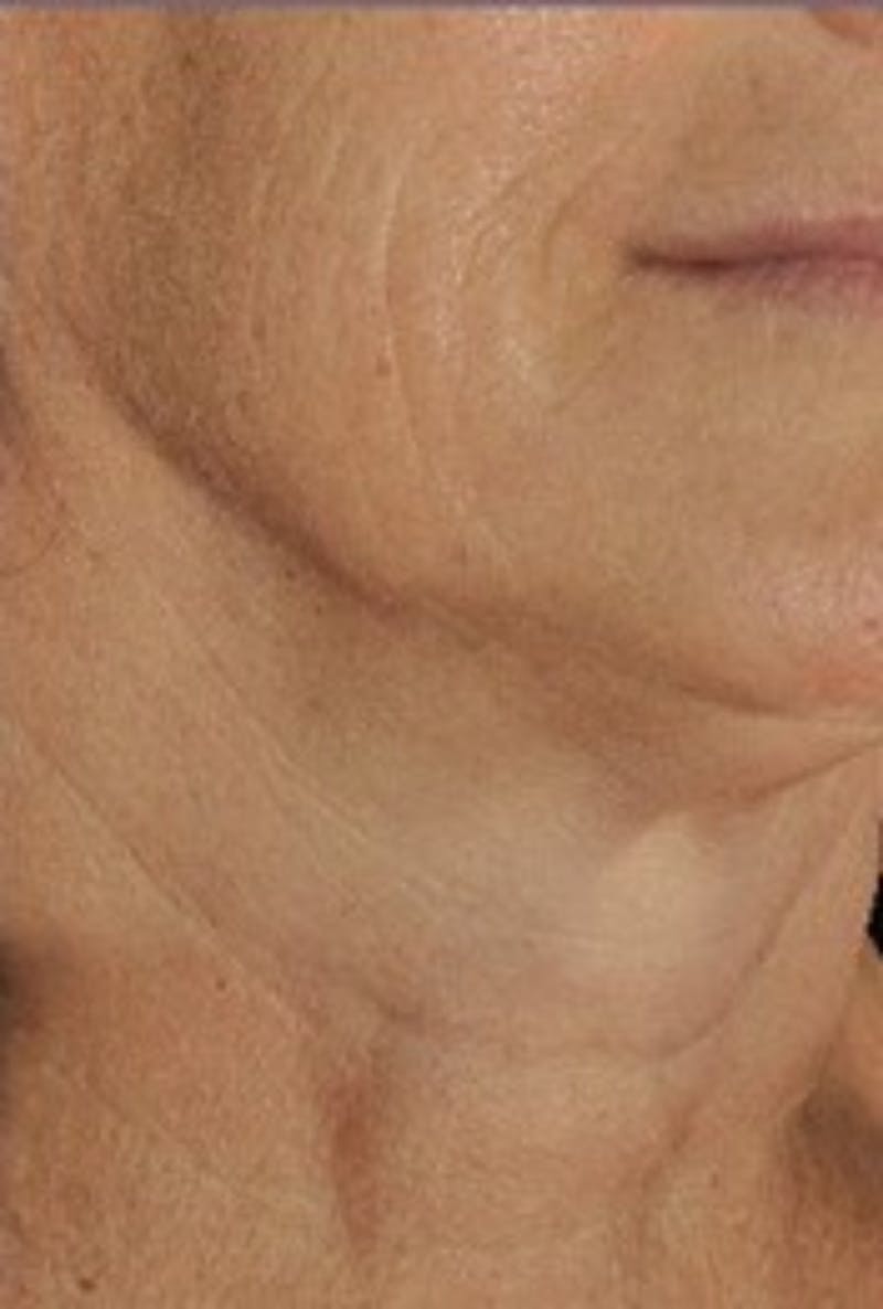 DefenAge Before & After Gallery - Patient 121027 - Image 1