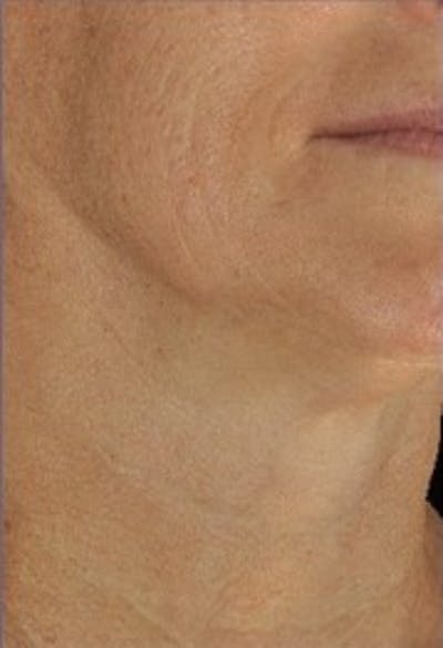 DefenAge Before & After Gallery - Patient 121027 - Image 2