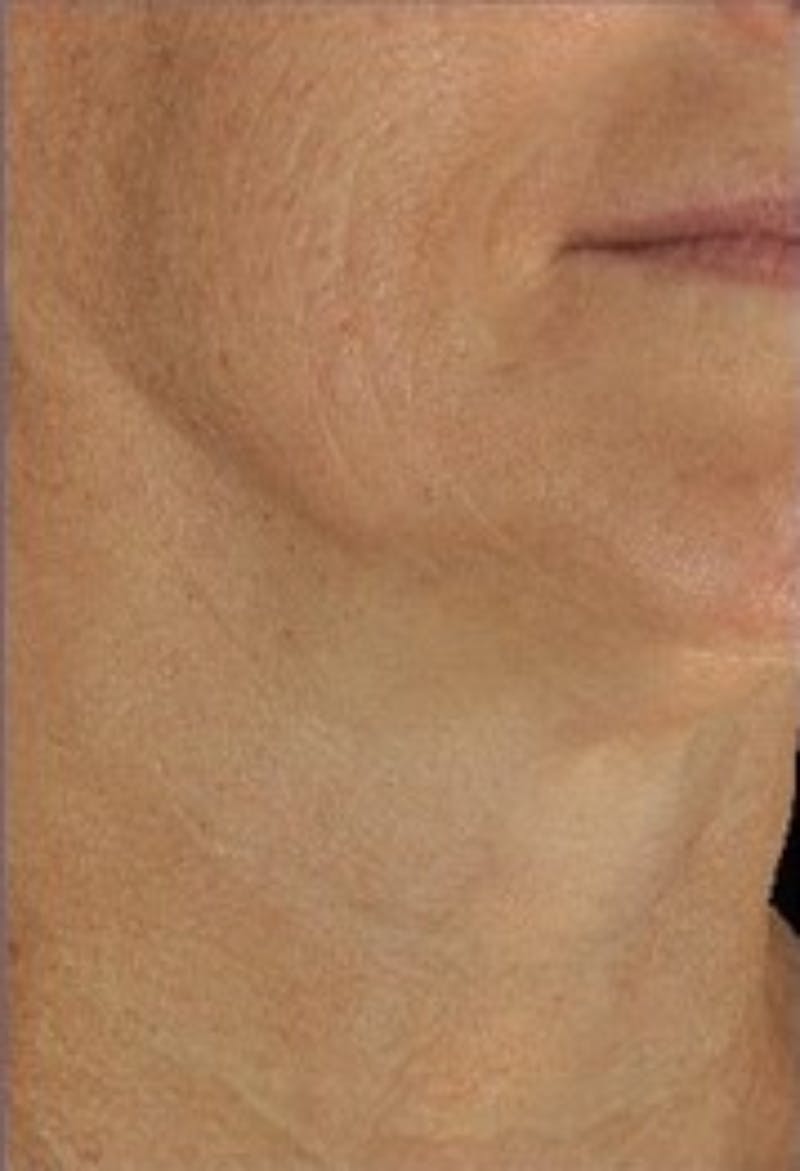 DefenAge Before & After Gallery - Patient 121027 - Image 2