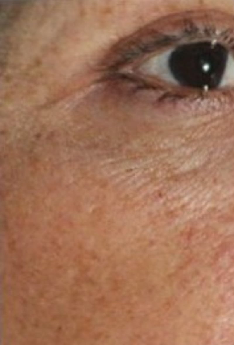 DefenAge Before & After Gallery - Patient 416430 - Image 1