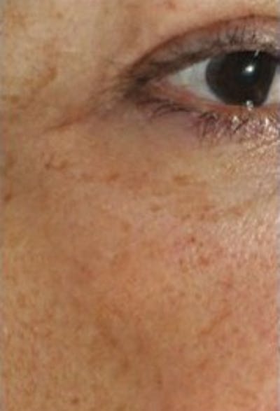 DefenAge Before & After Gallery - Patient 416430 - Image 2