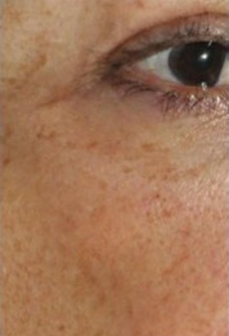 DefenAge Before & After Gallery - Patient 416430 - Image 2