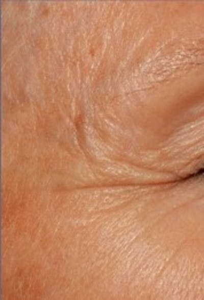 DefenAge Before & After Gallery - Patient 214149 - Image 1