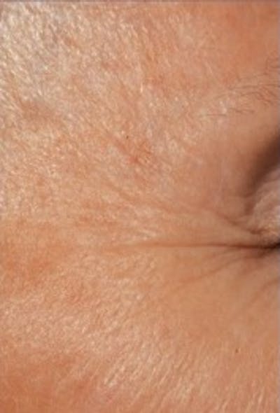 DefenAge Before & After Gallery - Patient 214149 - Image 2