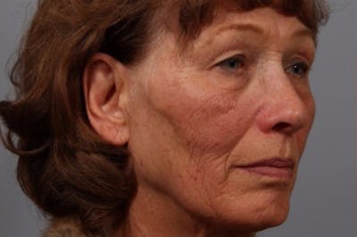 Laser Resurfacing Before & After Gallery - Patient 187789 - Image 1