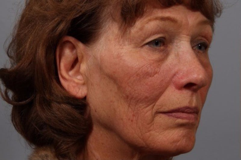 Laser Resurfacing Before & After Gallery - Patient 187789 - Image 1