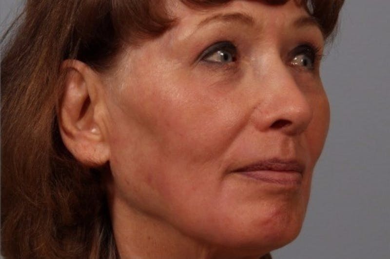 Laser Resurfacing Before & After Gallery - Patient 187789 - Image 2