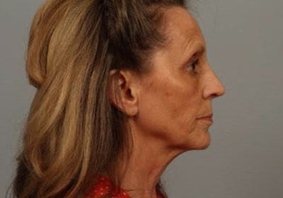 Laser Resurfacing Before & After Gallery - Patient 204560 - Image 1