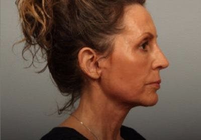 Laser Resurfacing Before & After Gallery - Patient 204560 - Image 2
