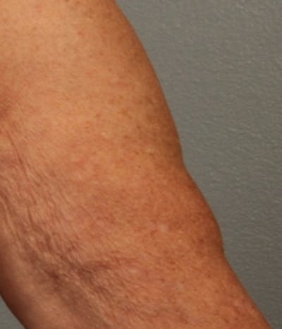 Laser Resurfacing Before & After Gallery - Patient 112379 - Image 1