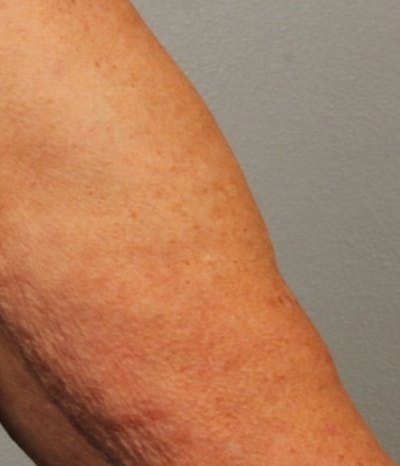 Laser Resurfacing Before & After Gallery - Patient 112379 - Image 2