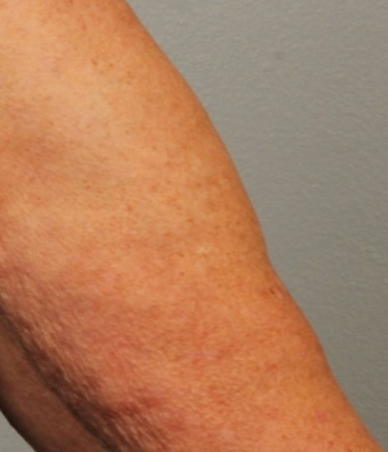 Laser Resurfacing Before & After Gallery - Patient 112379 - Image 2