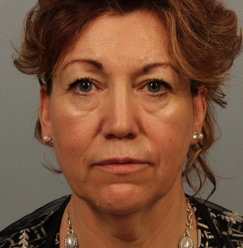 Laser Resurfacing Before & After Gallery - Patient 277725 - Image 1