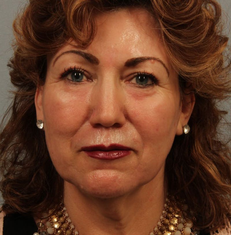 Laser Resurfacing Before & After Gallery - Patient 277725 - Image 2