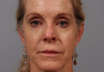 Laser Resurfacing Before & After Gallery - Patient 150121 - Image 1