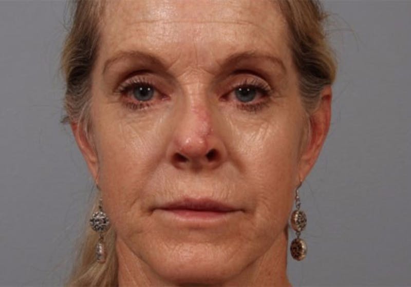 Laser Resurfacing Before & After Gallery - Patient 150121 - Image 1
