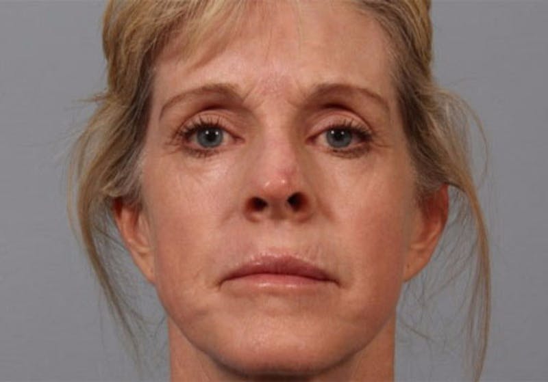 Laser Resurfacing Before & After Gallery - Patient 150121 - Image 2