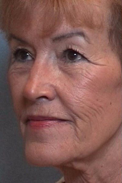 Laser Resurfacing Before & After Gallery - Patient 106177 - Image 1