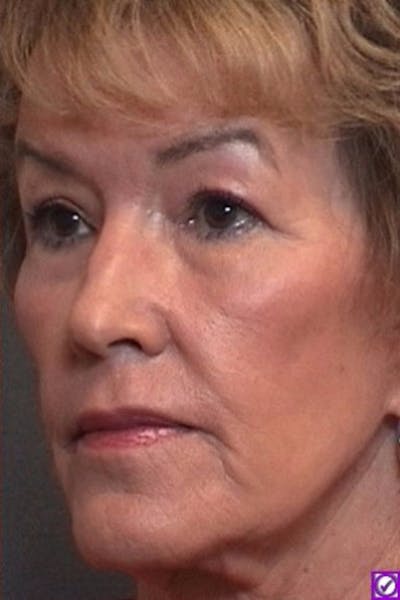 Laser Resurfacing Before & After Gallery - Patient 106177 - Image 2