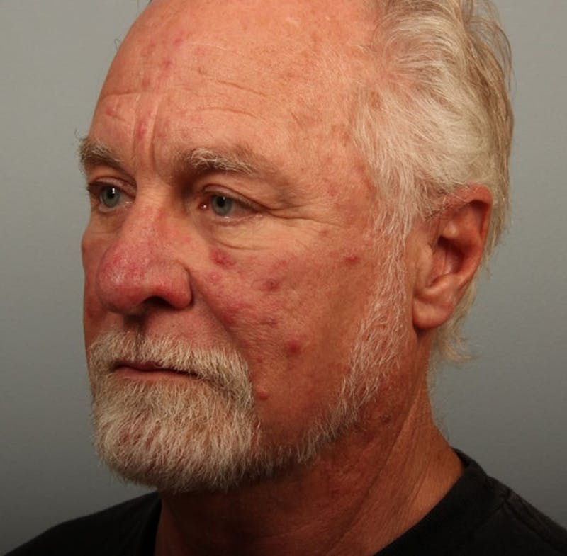 Laser Resurfacing Before & After Gallery - Patient 325873 - Image 1