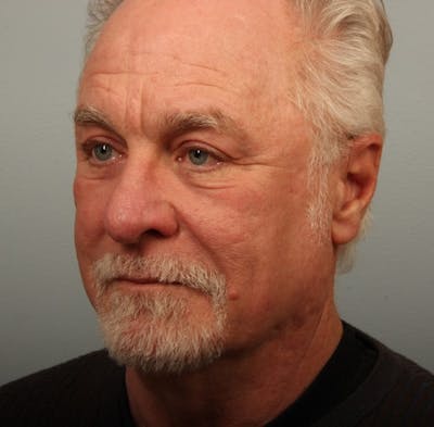 Laser Resurfacing Before & After Gallery - Patient 325873 - Image 2