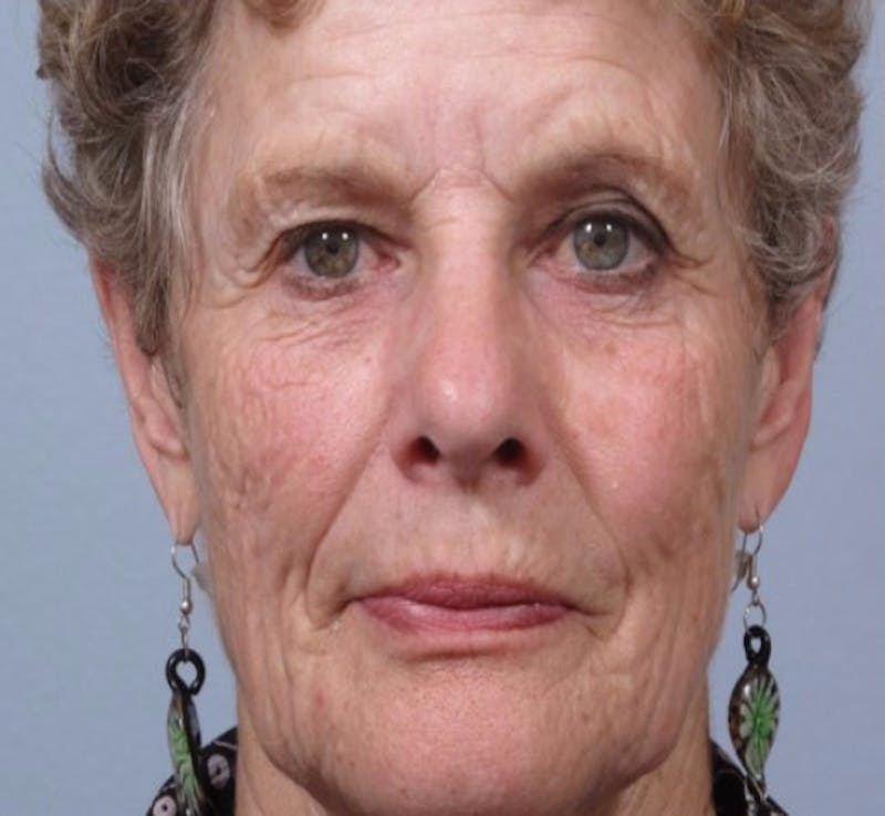 Laser Resurfacing Before & After Gallery - Patient 135014 - Image 1