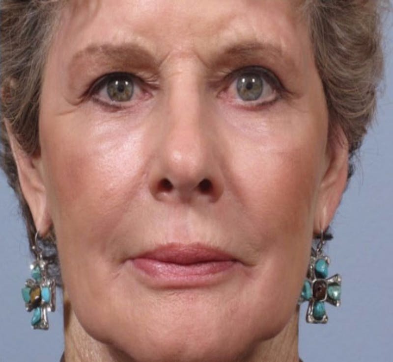 Laser Resurfacing Before & After Gallery - Patient 135014 - Image 2