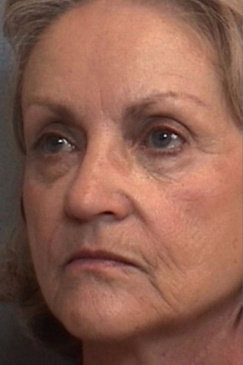 Laser Resurfacing Before & After Gallery - Patient 353869 - Image 1