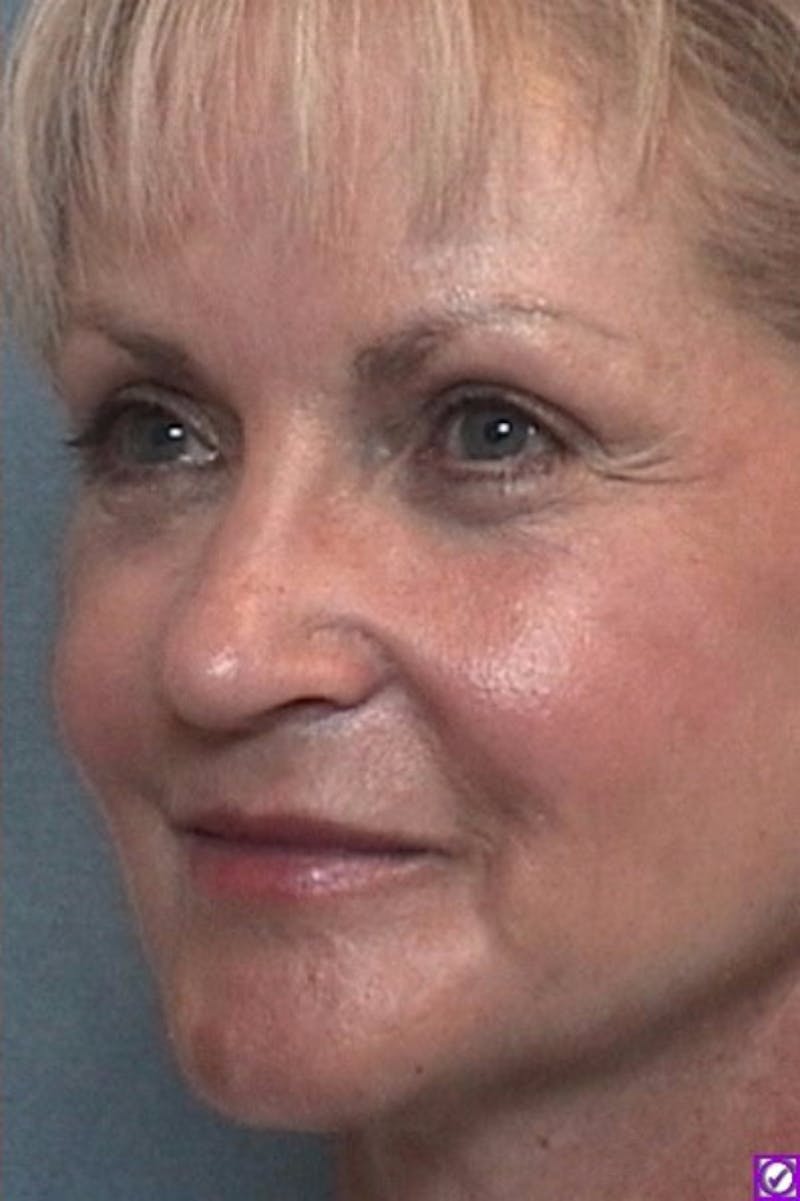 Laser Resurfacing Before & After Gallery - Patient 353869 - Image 2