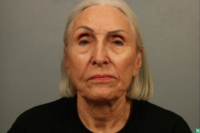 Laser Resurfacing Before & After Gallery - Patient 234097 - Image 1