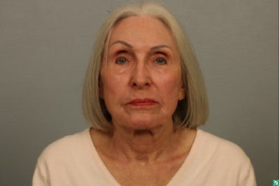 Laser Resurfacing Before & After Gallery - Patient 234097 - Image 2