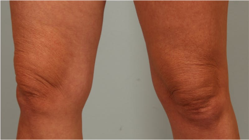 Microneedling Before & After Gallery - Patient 450576 - Image 1