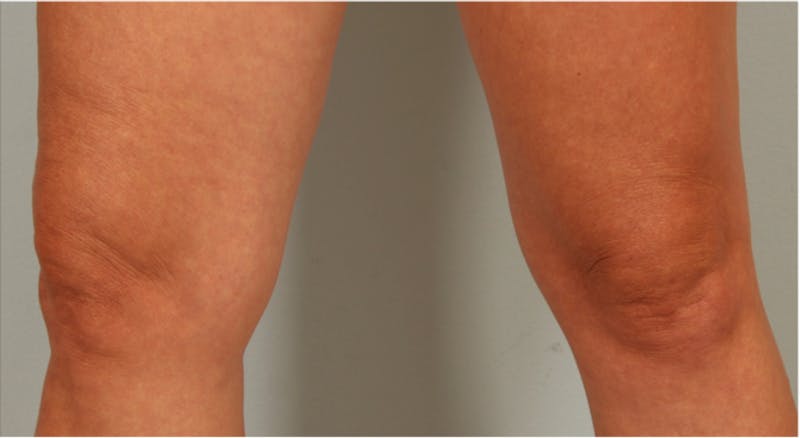 Microneedling Before & After Gallery - Patient 450576 - Image 2