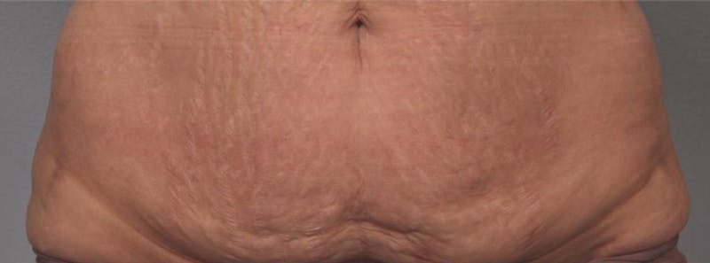 Microneedling Before & After Gallery - Patient 233223 - Image 1