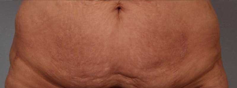 Microneedling Before & After Gallery - Patient 233223 - Image 2