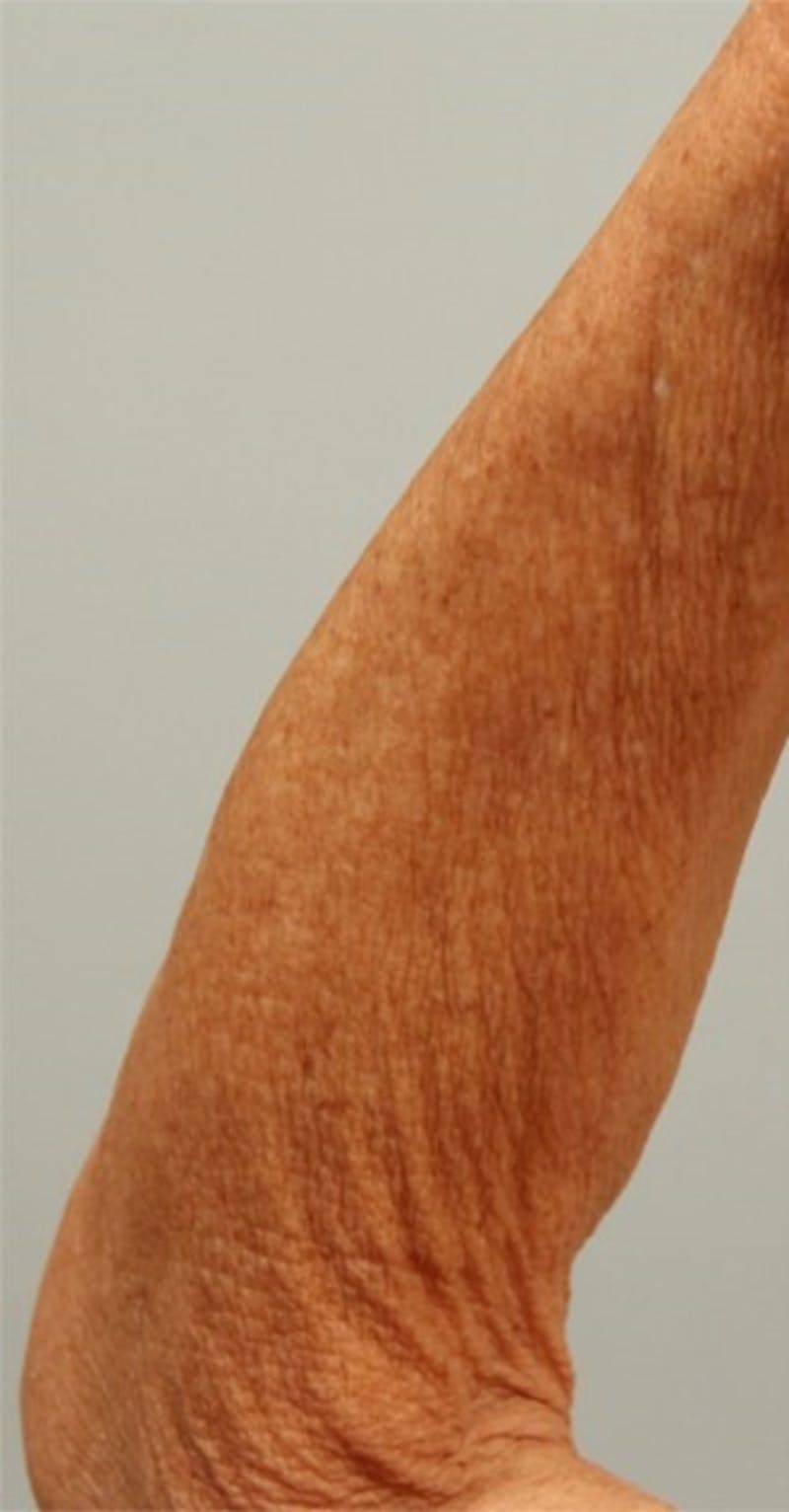 Microneedling Before & After Gallery - Patient 153339 - Image 1